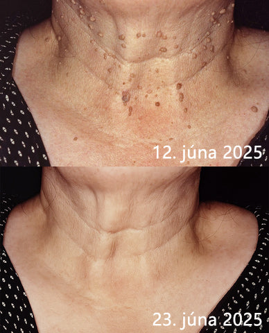 ✨ Bikenda® – CO₂ laserové pero na odstraňovanie 🟤 materských znamienok, 🦠 bradavíc, 🔘 škvŕn a iných nedokonalostí pleti💄