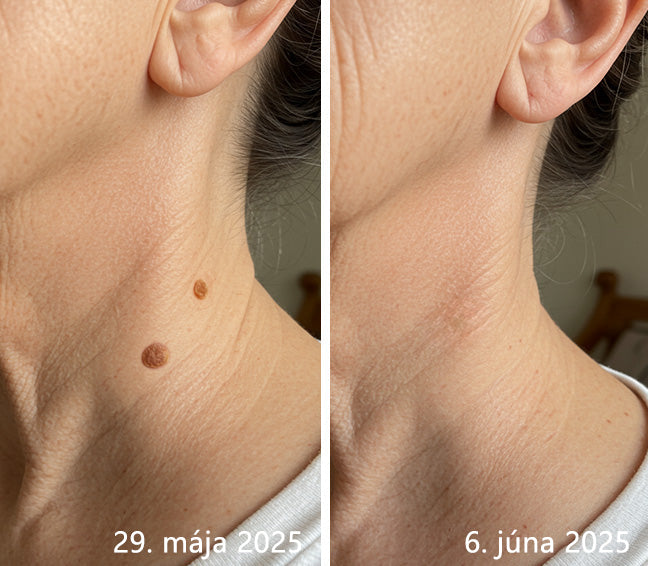 ✨ Bikenda® – CO₂ laserové pero na odstraňovanie 🟤 materských znamienok, 🦠 bradavíc, 🔘 škvŕn a iných nedokonalostí pleti💄