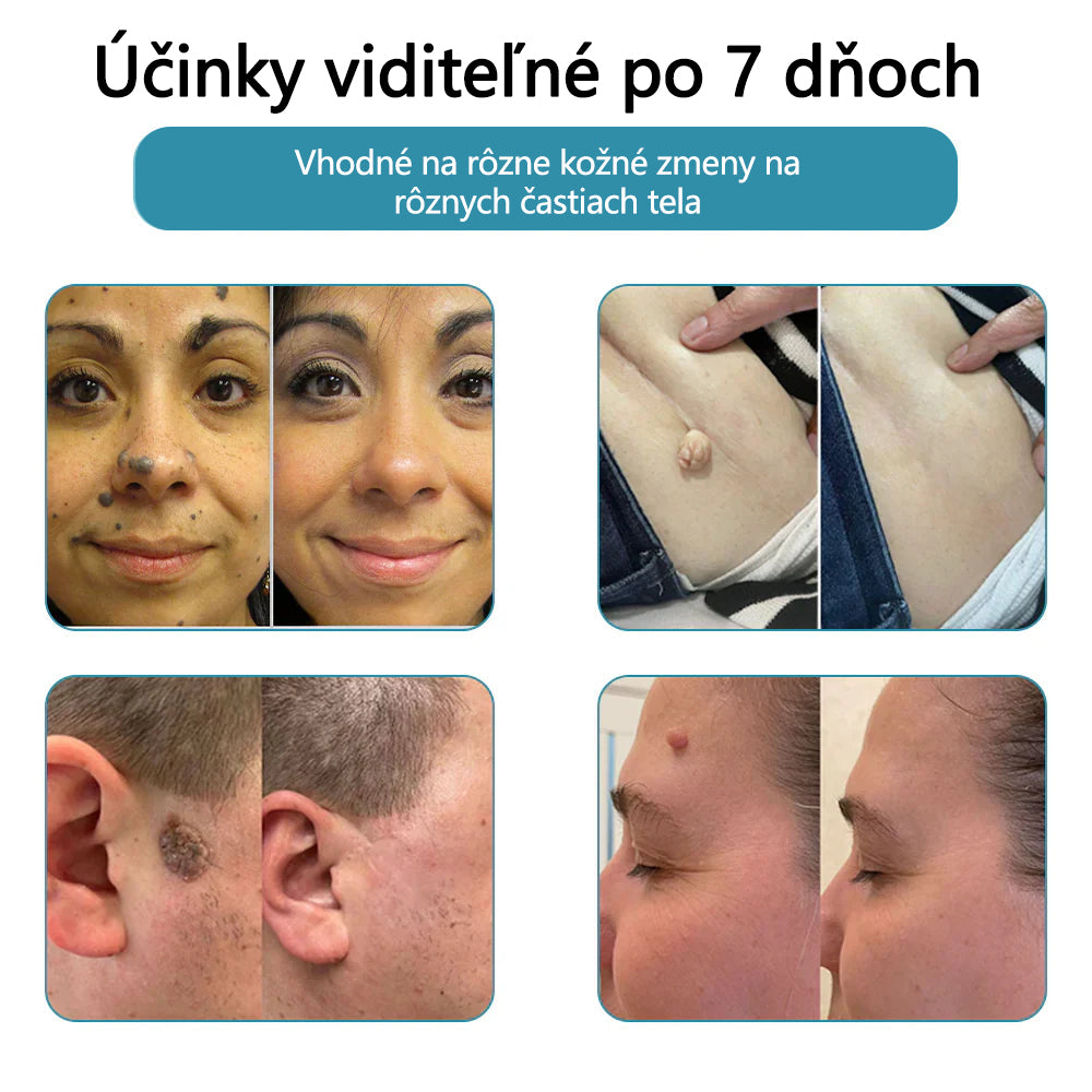 ✨ Bikenda® – CO₂ laserové pero na odstraňovanie 🟤 materských znamienok, 🦠 bradavíc, 🔘 škvŕn a iných nedokonalostí pleti💄