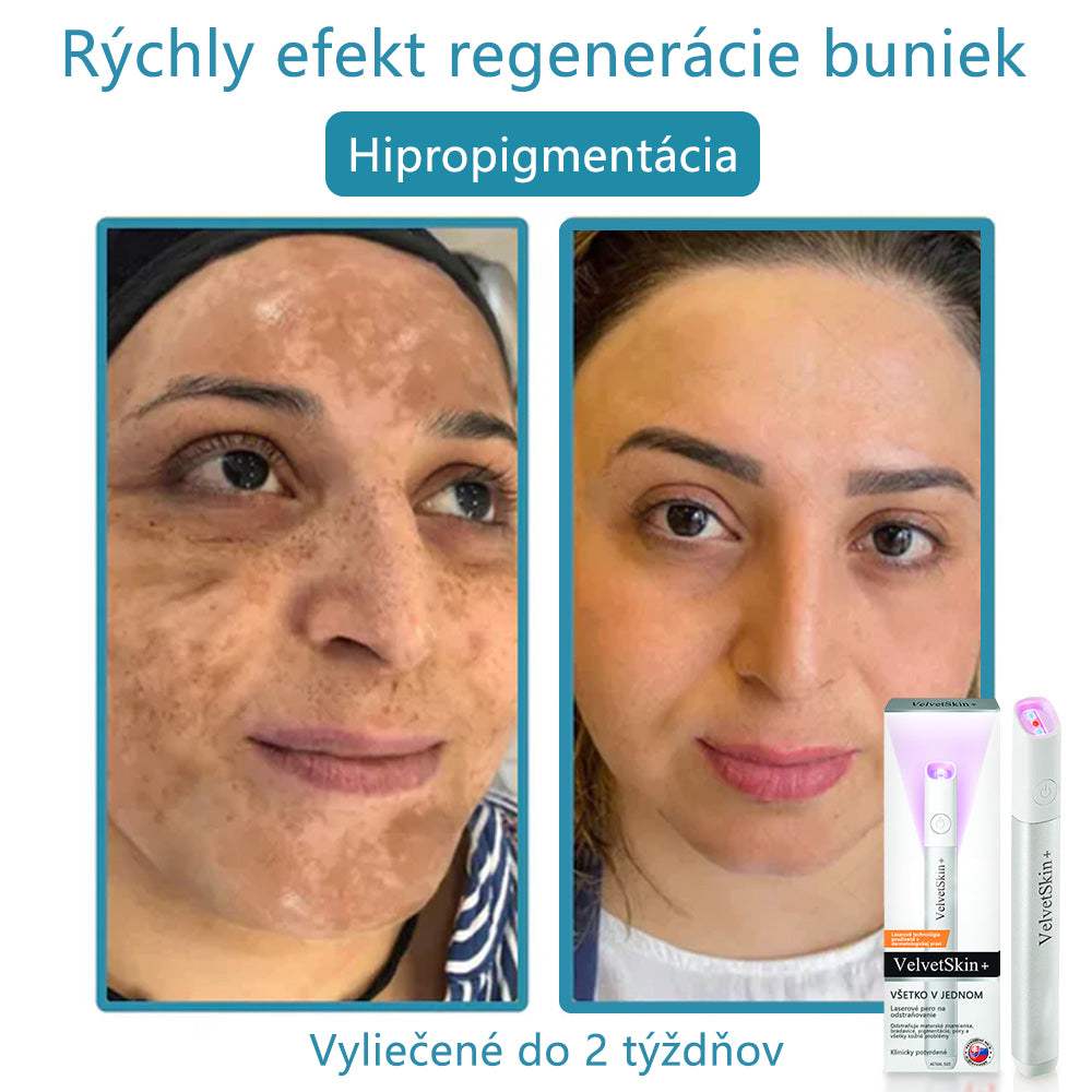 ✨ Bikenda® – CO₂ laserové pero na odstraňovanie 🟤 materských znamienok, 🦠 bradavíc, 🔘 škvŕn a iných nedokonalostí pleti💄