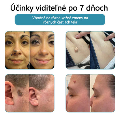 ✨ Bikenda® – CO₂ laserové pero na odstraňovanie 🟤 materských znamienok, 🦠 bradavíc, 🔘 škvŕn a iných nedokonalostí pleti💎