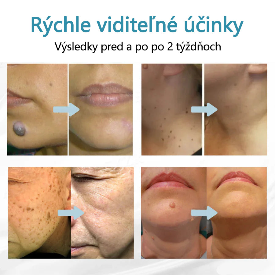 ✨ Bikenda® – CO₂ laserové pero na odstraňovanie 🟤 materských znamienok, 🦠 bradavíc, 🔘 škvŕn a iných nedokonalostí pleti💎