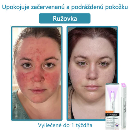 ✨ Bikenda® – CO₂ laserové pero na odstraňovanie 🟤 materských znamienok, 🦠 bradavíc, 🔘 škvŕn a iných nedokonalostí pleti💎