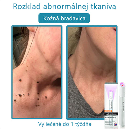 ✨ Bikenda® – CO₂ laserové pero na odstraňovanie 🟤 materských znamienok, 🦠 bradavíc, 🔘 škvŕn a iných nedokonalostí pleti💎