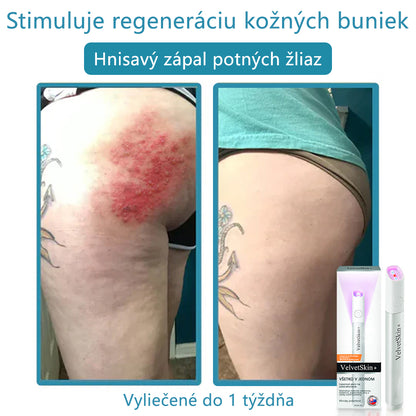 ✨ Bikenda® – CO₂ laserové pero na odstraňovanie 🟤 materských znamienok, 🦠 bradavíc, 🔘 škvŕn a iných nedokonalostí pleti💎